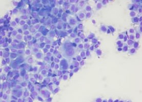 採取された腫瘍細胞の顕微鏡写真